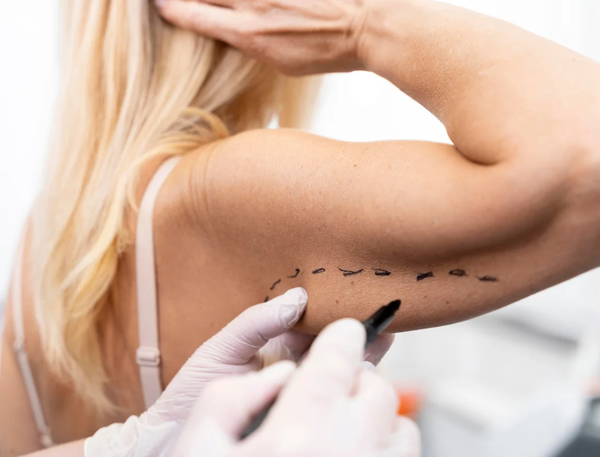 Epilare Definitivă Laser